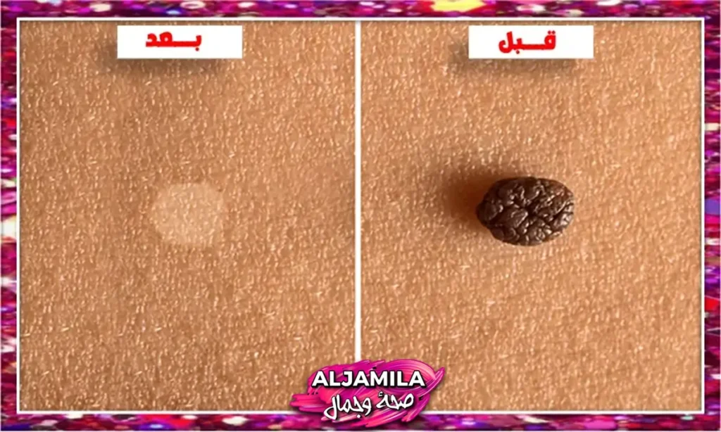 تجربتي قبل وبعد استئصال شامتي بالليزر