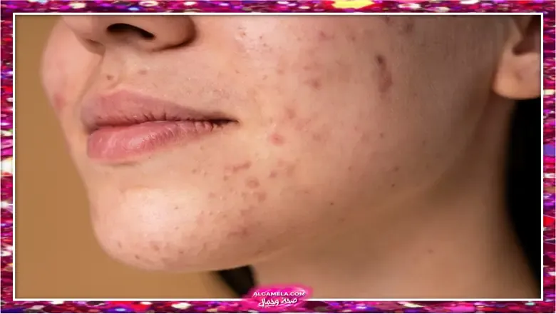 ما هي البشرة الحساسة وهل هي حالة مرضية؟ المعرضة للحساسية والأكزيما