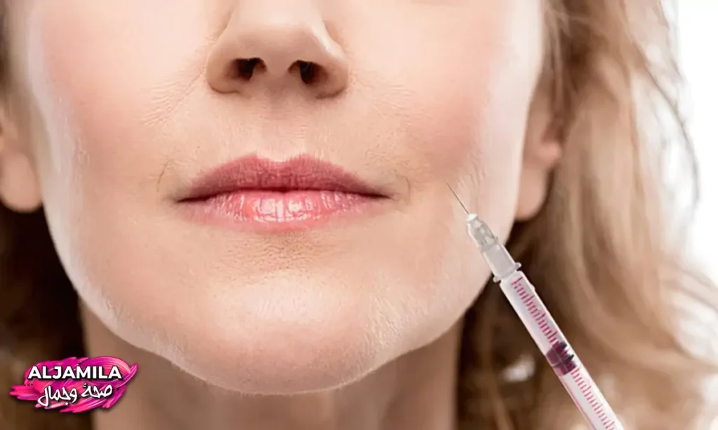 حقن البوتكس حول الشفاه