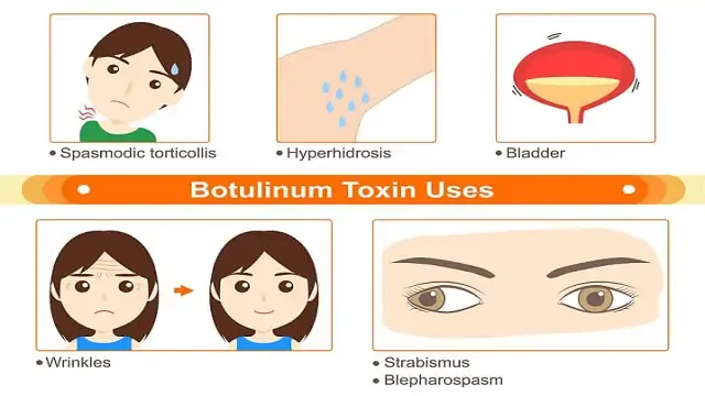 سم البوتولينيوم botulinum toxin