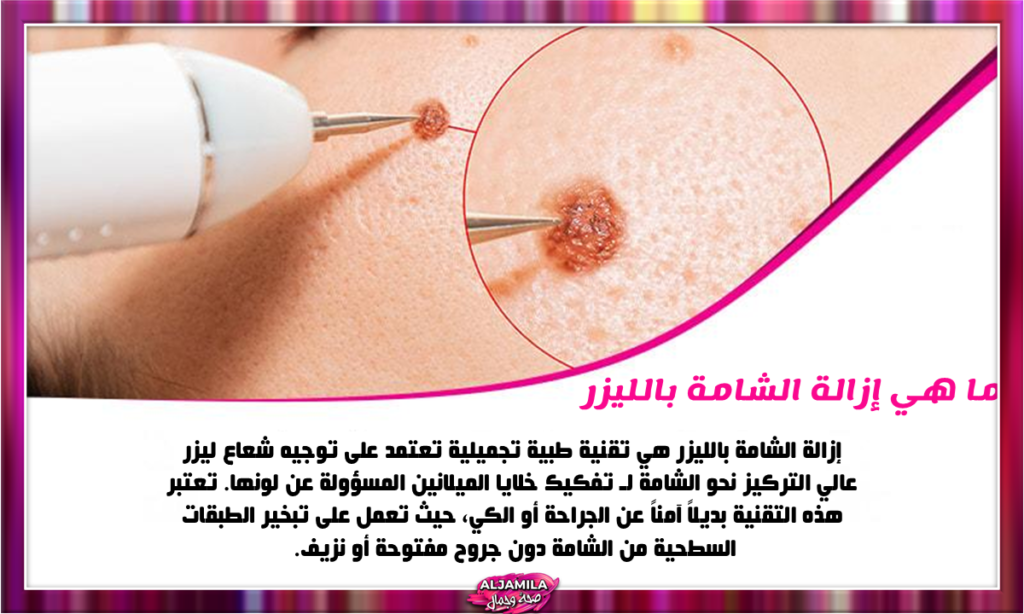 ما هي إزالة الشامة بالليزر؟