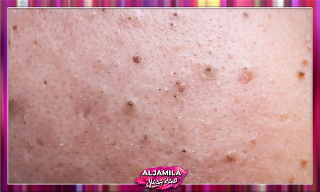 الرؤوس السوداء Blackheads