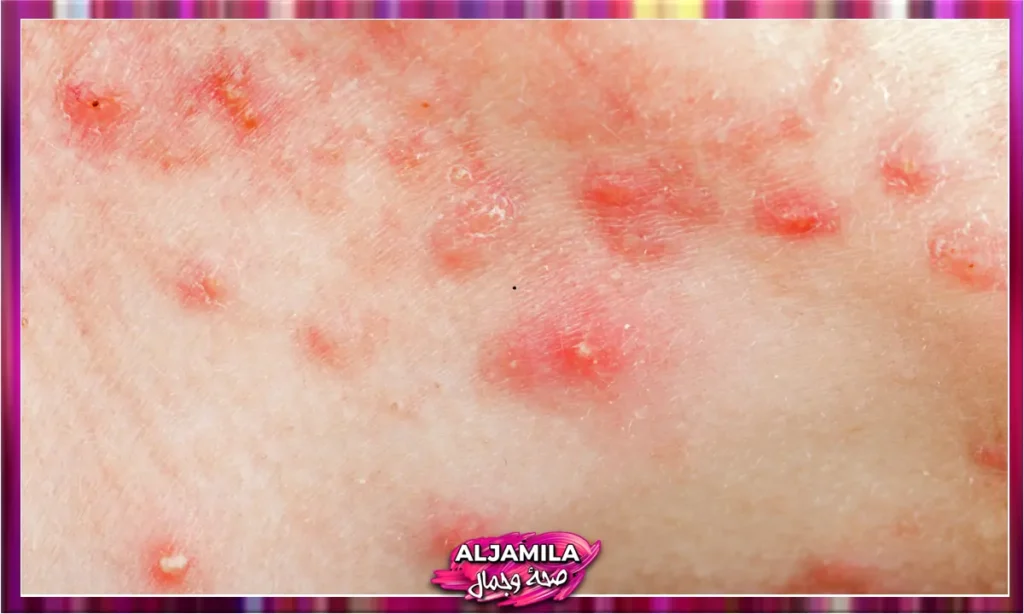 حب الشباب الكيسي Cystic Acne