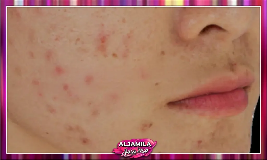 الحطاطات Papules