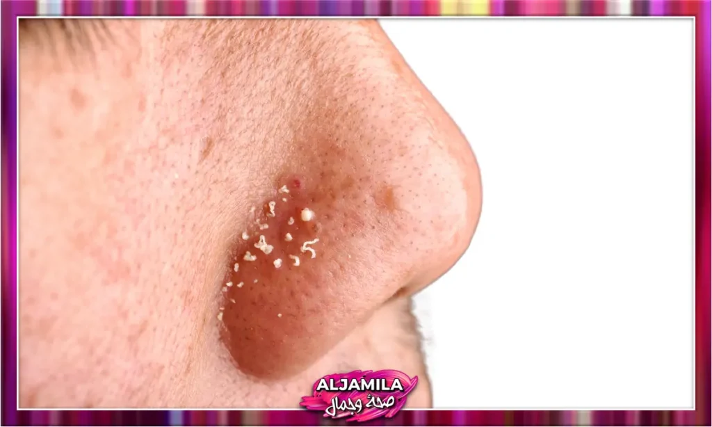 الرؤوس البيضاء Whiteheads