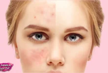 ما هو حب الشباب Acne الذي يختبئ تحت الجلد لشهور قبل أن يظهر على السطح؟