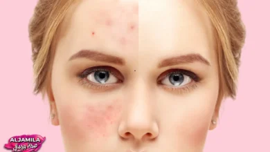 ما هو حب الشباب Acne الذي يختبئ تحت الجلد لشهور قبل أن يظهر على السطح؟