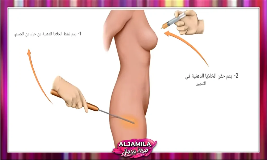 حقن دهون الجسم الذاتية في الثدي