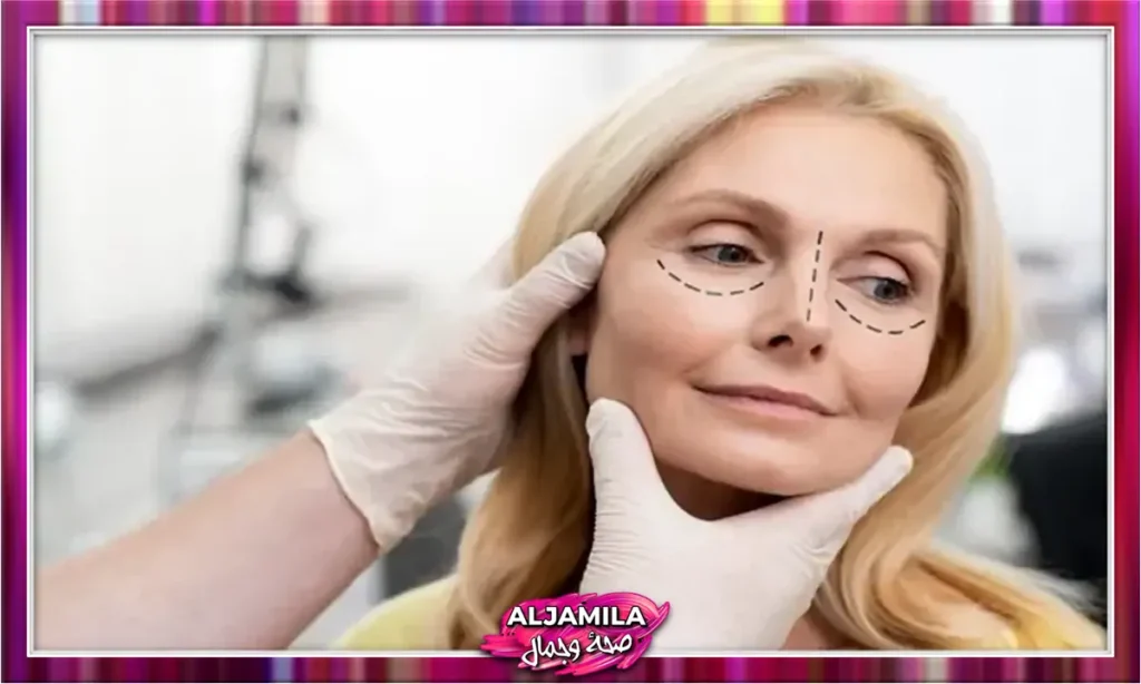 رأب الجفن (Blepharoplasty)
