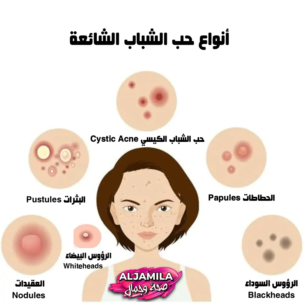 أنواع حب الشباب