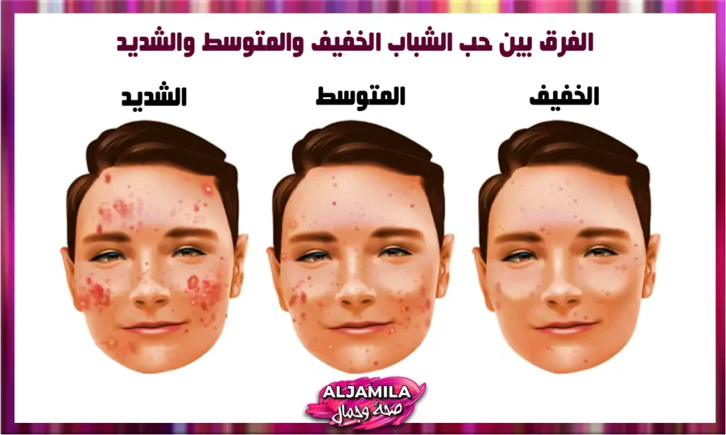 ما الفرق بين حب الشباب الخفيف والمتوسط والشديد؟