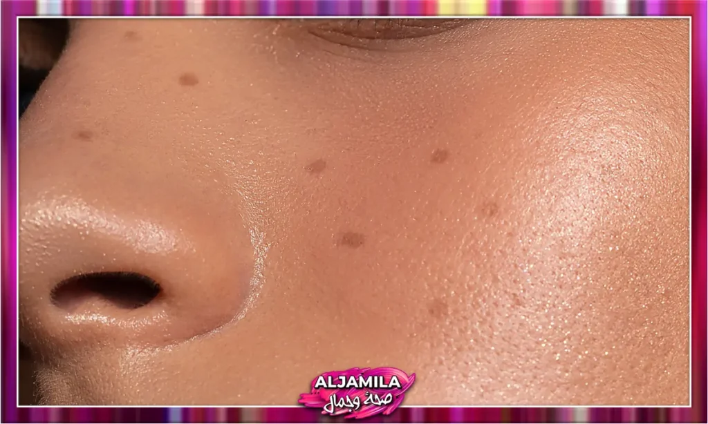 ما هي البشرة المختلطة Combination Skin؟