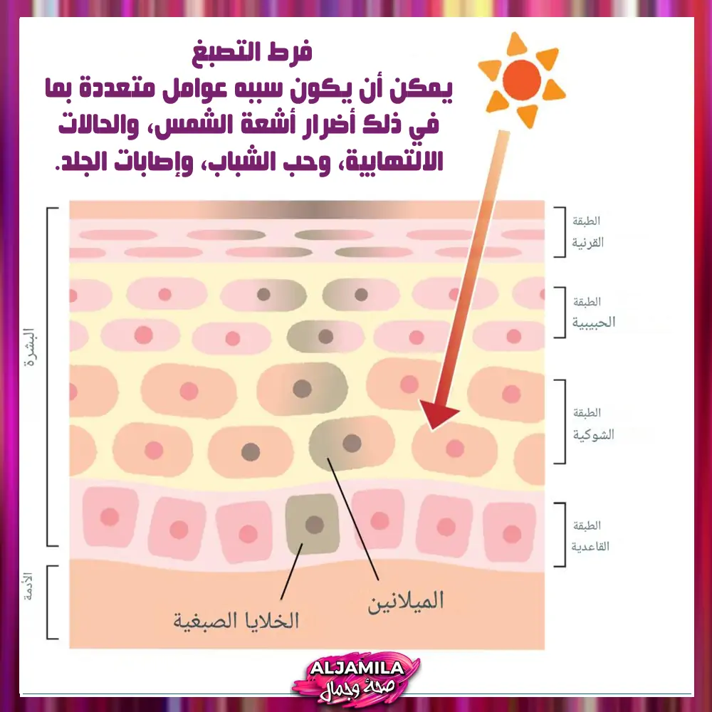 ما هو فرط التصبغ ولماذا يحدث؟
